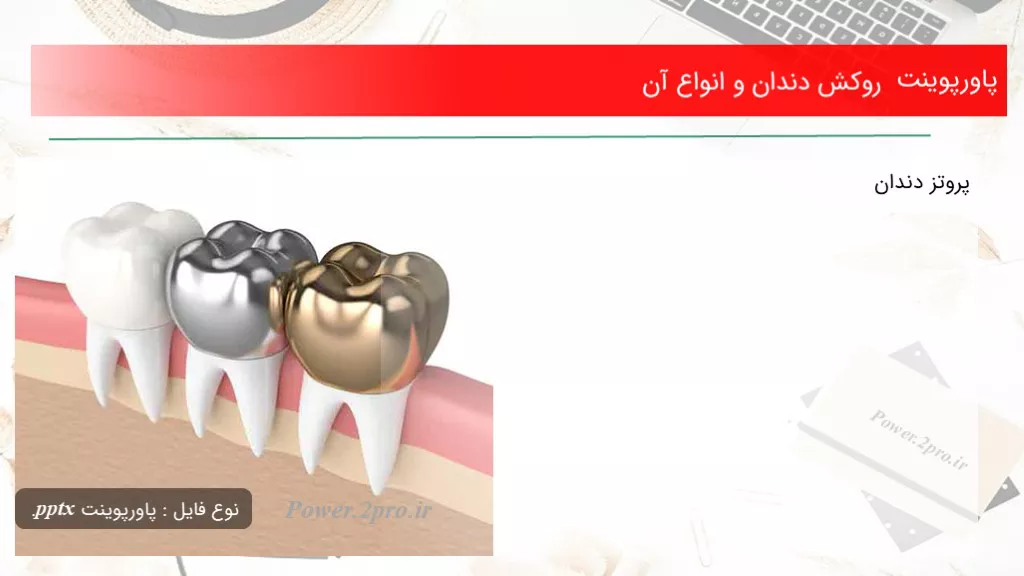 روکش دندان و انواع آن