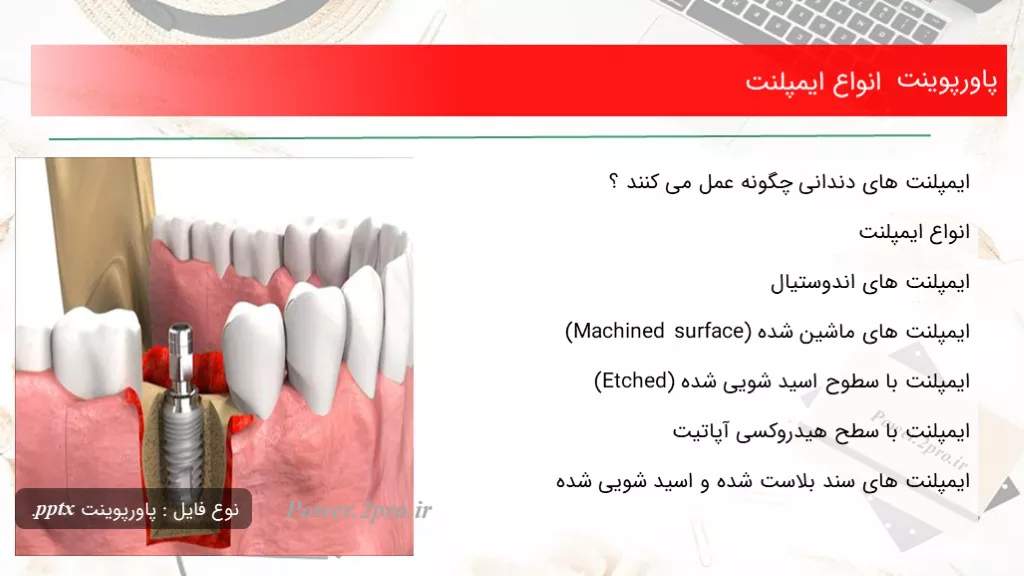 دانلود پاورپوینت انواع ایمپلنت  - کد108047