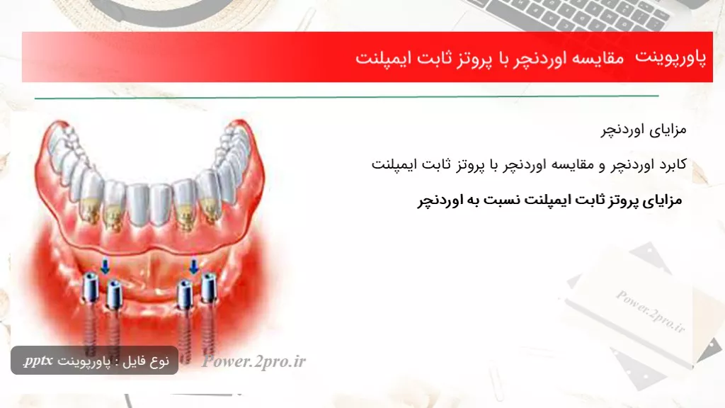 دانلود پاورپوینت مقایسه اوردنچر با پروتز ثابت ایمپلنت - کد108052