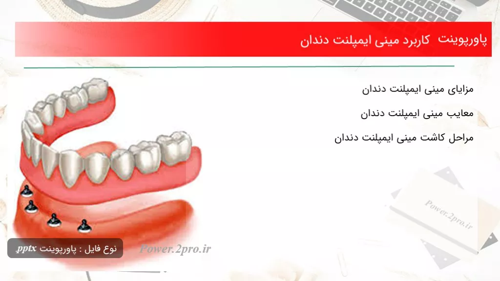 دانلود پاورپوینت استفاده مینی ایمپلنت دندان - کد108053