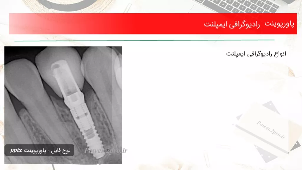 دانلود پاورپوینت رادیوگرافی ایمپلنت - کد108067