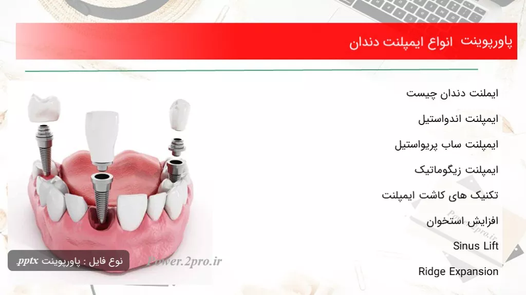 Zygomatic implants