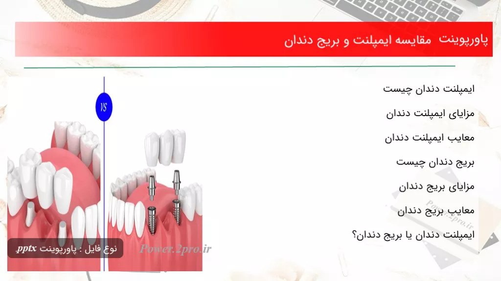 مقایسه ایمپلنت و بریج دندان