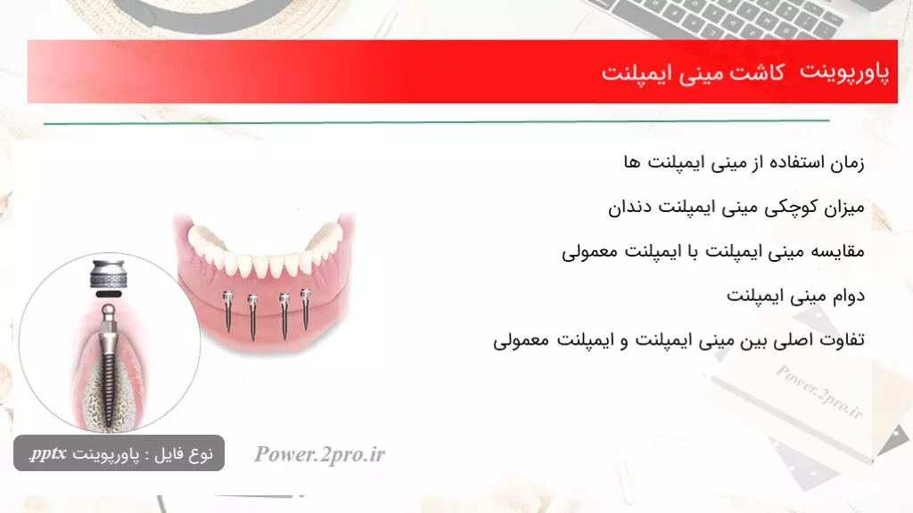 دانلود پاورپوینت کاشت مینی ایمپلنت - کد108120