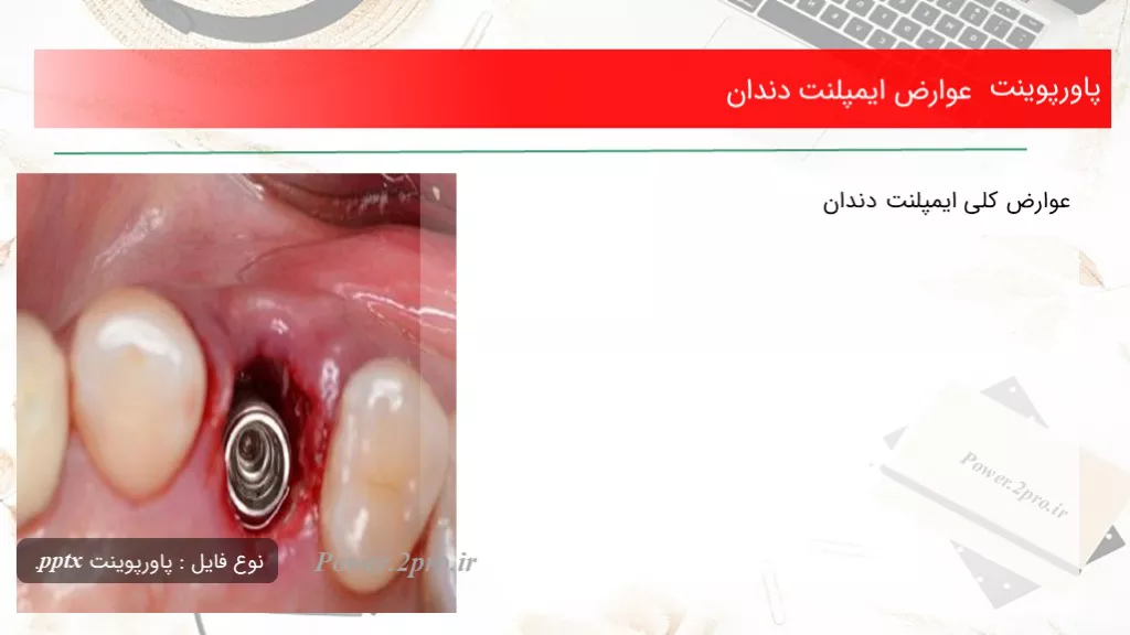 دانلود پاورپوینت عوارض ایمپلنت دندان - کد108133