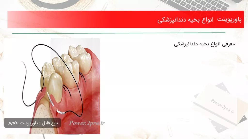 انواع بخیه دندانپزشکی