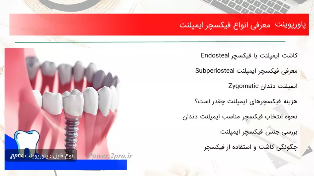 معرفی انواع فیکسچر ایمپلنت