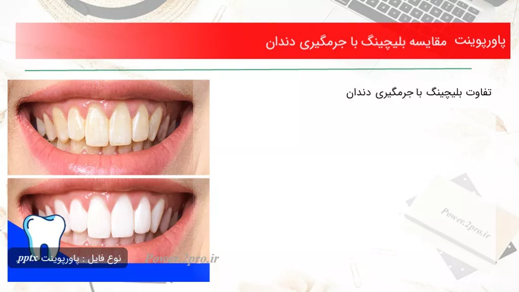 دانلود پاورپوینت مقایسه بلیچینگ با جرمگیری دندان - کد108263