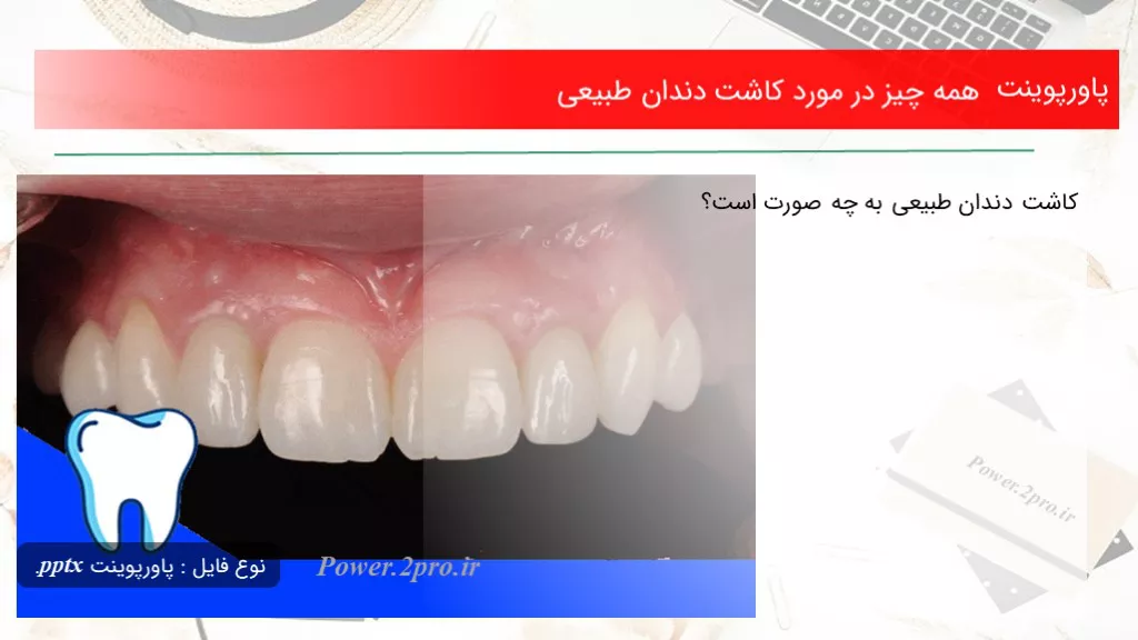 دانلود پاورپوینت همه موارد در ضمینه کاشت دندان طبیعی - کد108264