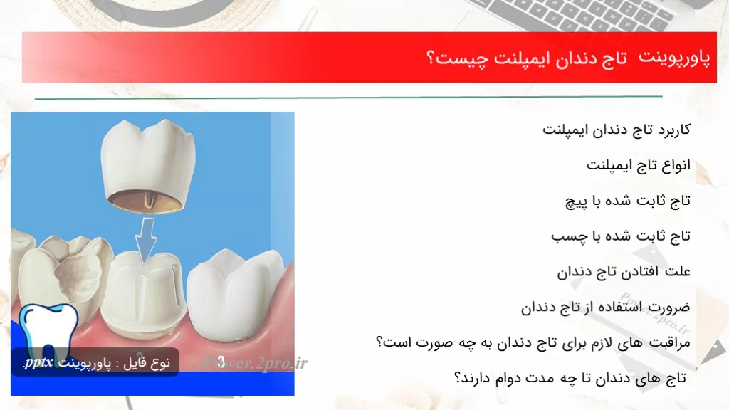 دانلود پاورپوینت تاج دندان ایمپلنت چه چیزی است ؟ - کد108265