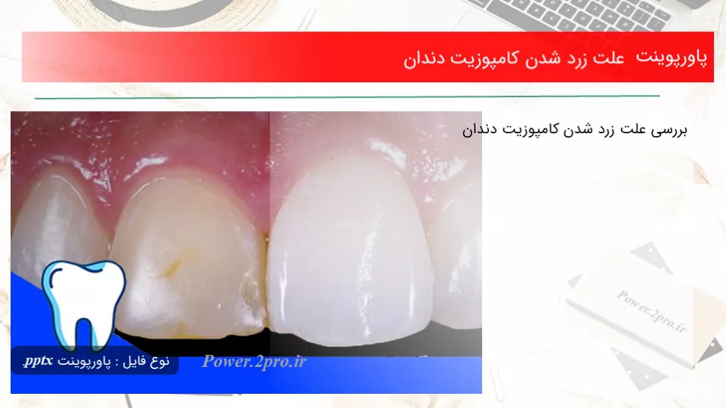 دانلود پاورپوینت چرایی زرد شدن کامپوزیت دندان - کد108281