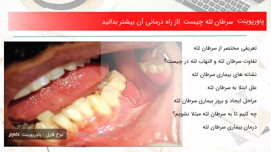 دانلود پاورپوینت سرطان لثه چه چیزی است | از راه درمانی آن اکثر بدانید - کد108287