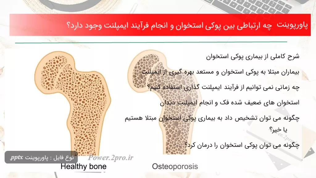 دانلود پاورپوینت چه ارتباطی میان پوکی استخوان و انجام فرآیند ایمپلنت وجود دارد؟ - کد108290