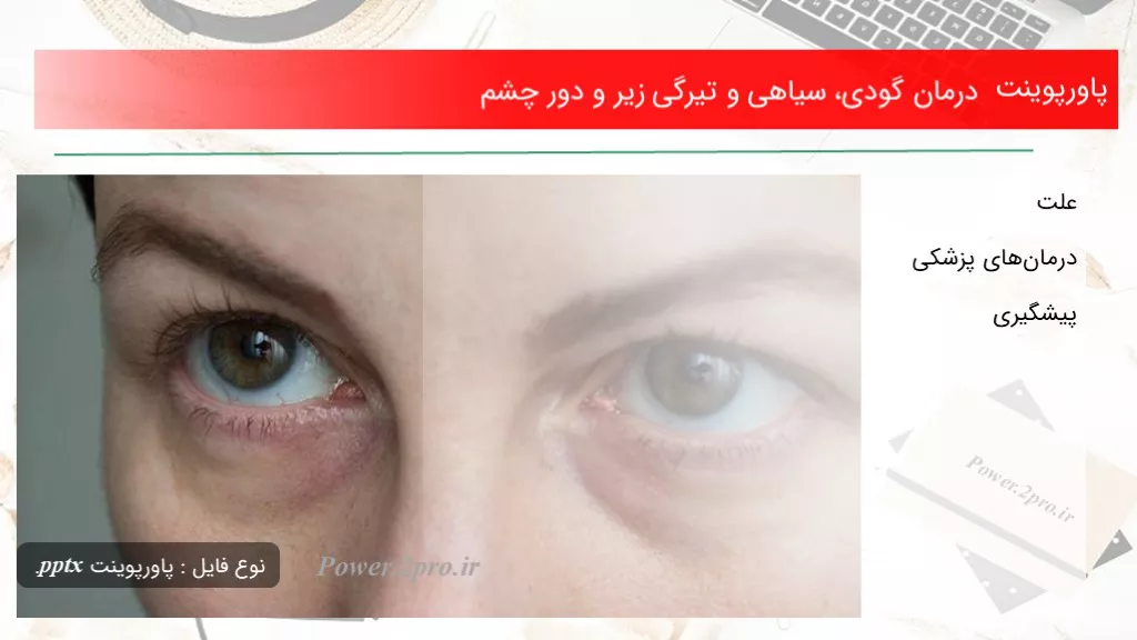 دانلود پاورپوینت درمان گودی، سیاهی و تیرگی زیر و دور چشم - کد108437