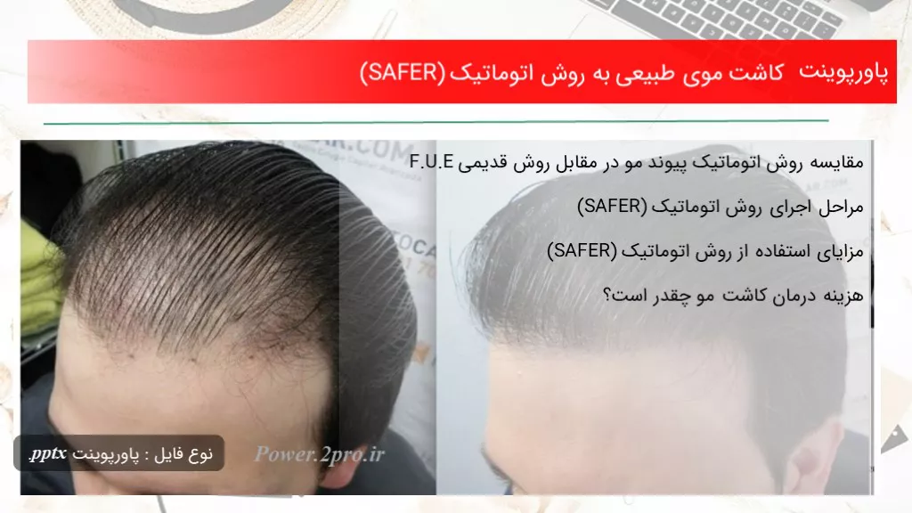 دانلود پاورپوینت کاشت موی طبیعی به چگونگی اتوماتیک (SAFER) - کد108442