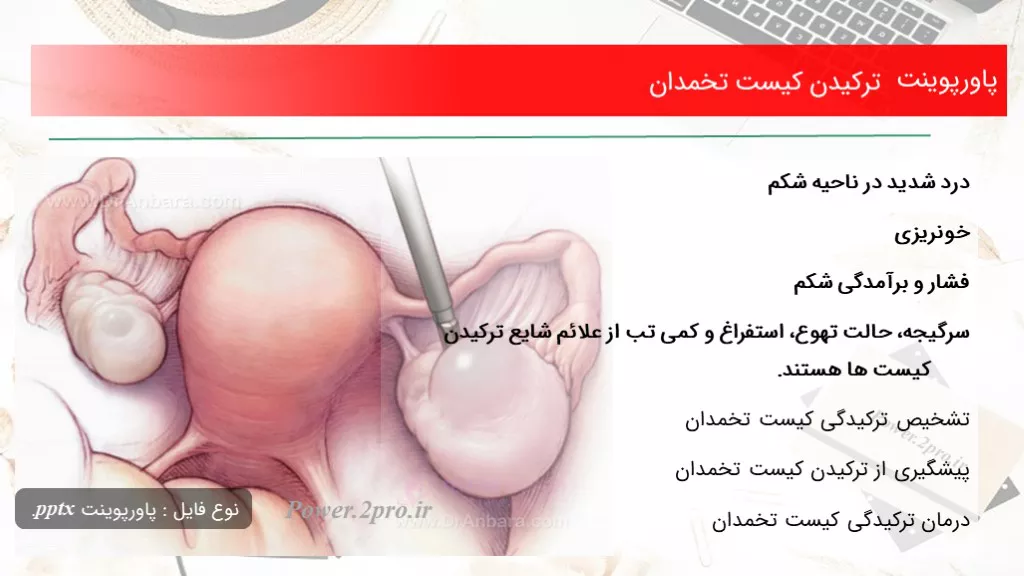 دانلود پاورپوینت ترکیدن کیست تخمدان - کد109212