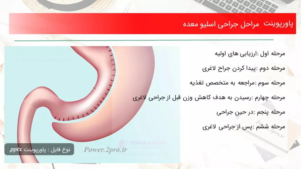 مراحل جراحی اسلیو معده