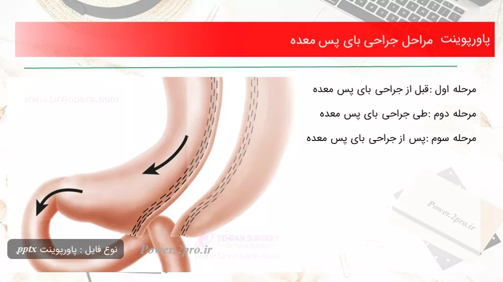  جراحی بای پس معده