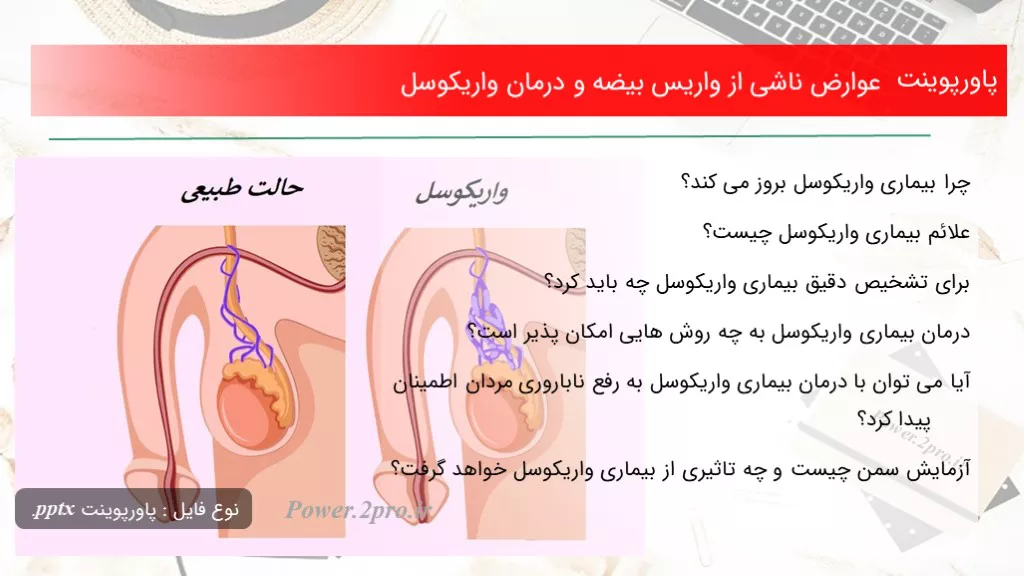 عوارض ناشی از واریس بیضه و درمان واریکوسل