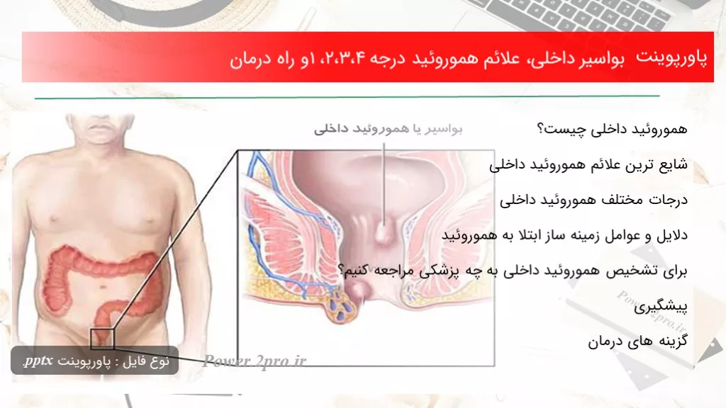 بواسیر داخلی، علائم هموروئید درجه 4،3،2،1 و راه درمان