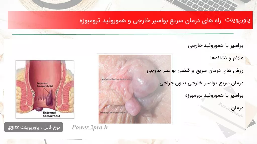 دانلود پاورپوینت راه های درمان سریع بواسیر خارجی و هموروئید ترومبوزه - کد109866