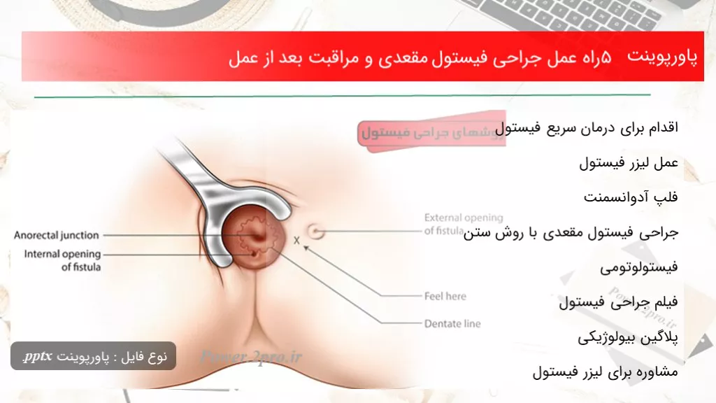 5 راه عمل جراحی فیستول مقعدی و مراقبت‌ بعد از عمل