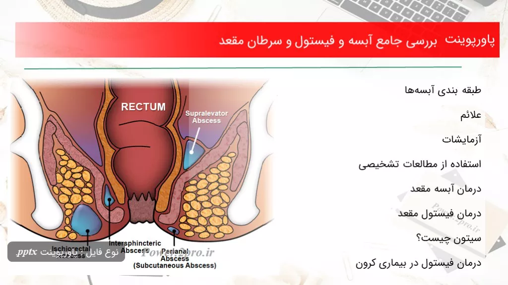 دانلود پاورپوینت بررسی جامع آبسه و فیستول و سرطان مقعد - کد109880