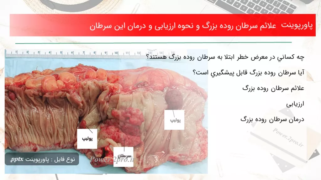 علائم سرطان روده بزرگ و نحوه ارزیابی و درمان این سرطان