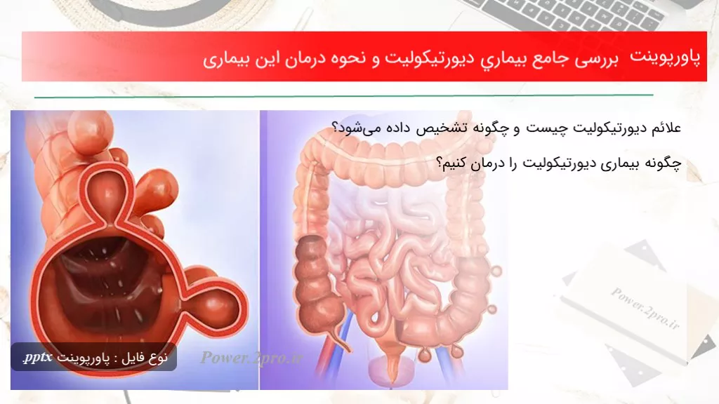 Diverticulitis 