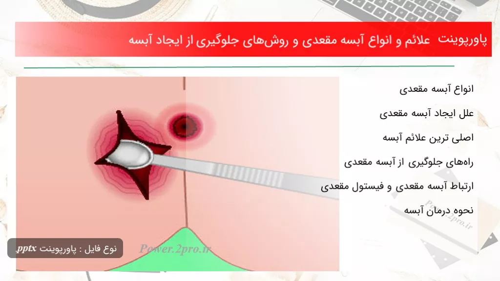 دانلود پاورپوینت علائم و انواع آبسه مقعدی و روش‌های جلوگیری از ایجاد آبسه - کد109900