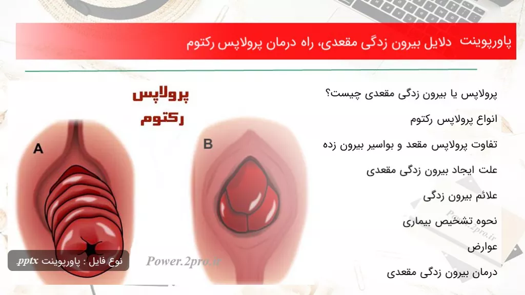 دلایل بیرون زدگی مقعدی، راه درمان پرولاپس رکتوم