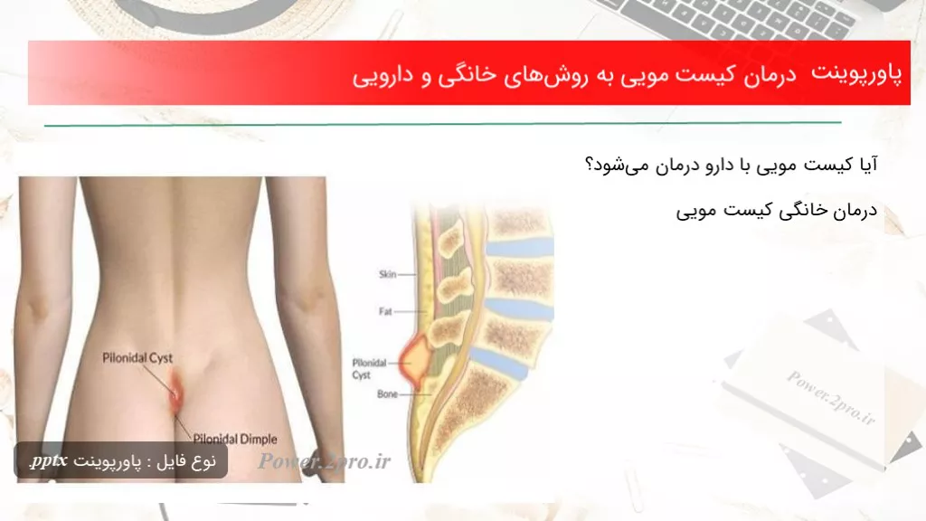 درمان کیست مویی به روش‌های خانگی و دارویی