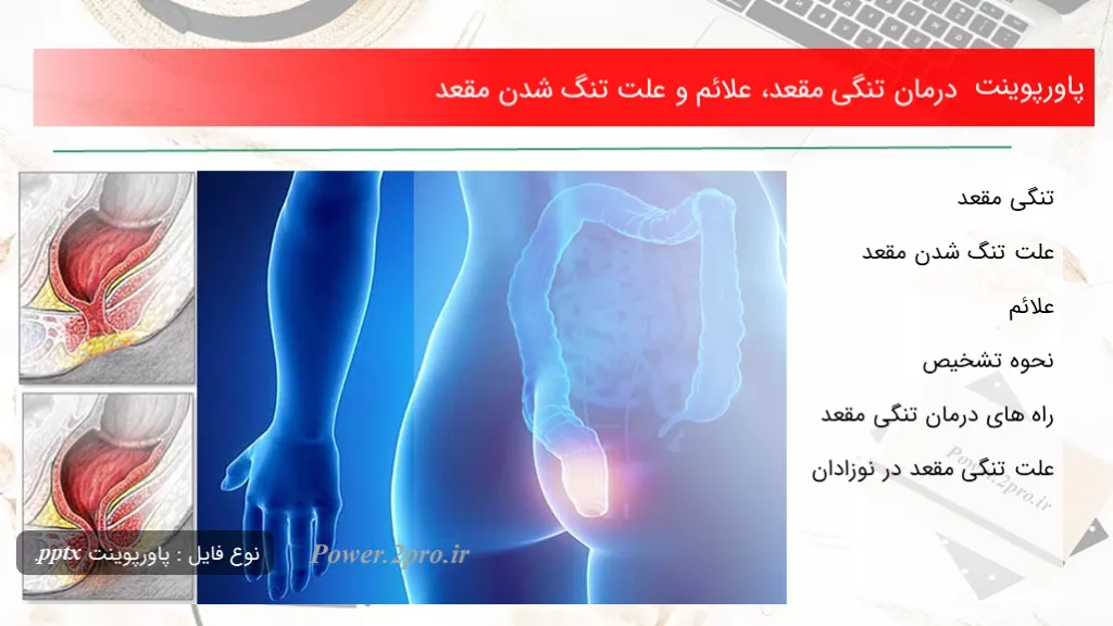 دانلود پاورپوینت درمان تنگی مقعد، علائم و چرایی تنگ شدن مقعد - کد109926