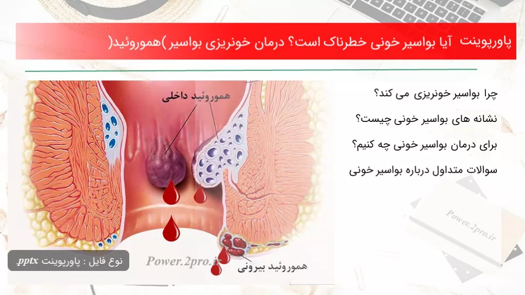 دانلود پاورپوینت آیا بواسیر خونی خطرناک است؟ درمان خونریزی بواسیر (هموروئید) - کد109927