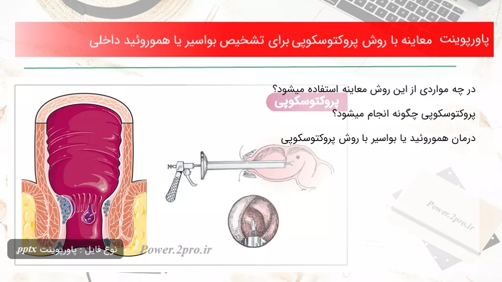 دانلود پاورپوینت معاینه با چگونگی پروکتوسکوپی به منظور تشخیص بواسیر یا هموروئید داخلی - کد109951