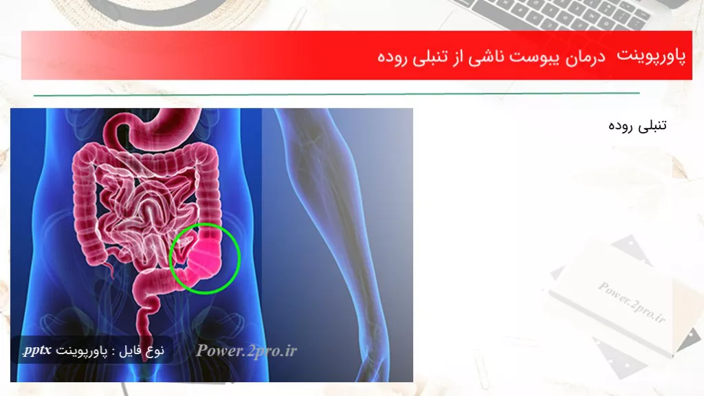 دانلود پاورپوینت درمان یبوست ناشی از تنبلی روده - کد110656