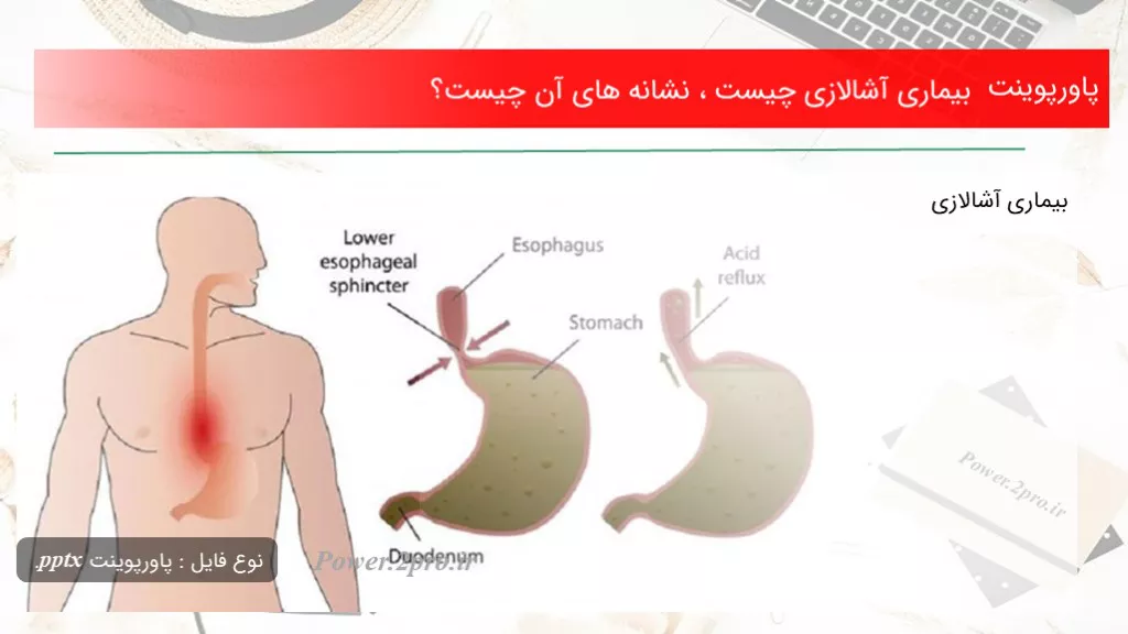 دانلود پاورپوینت بیماری آشالازی چه چیزی است ، نشانه های آن چه چیزی است ؟ - کد110668