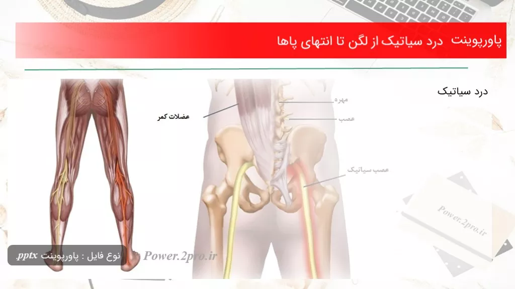 دانلود پاورپوینت درد سیاتیک از لگن تا انتهای پاها - کد110685