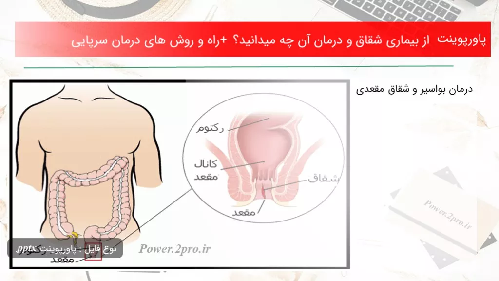 دانلود پاورپوینت از بیماری شقاق و درمان آن چه میدانید؟ + راه و چگونگی های درمان سرپایی - کد110695