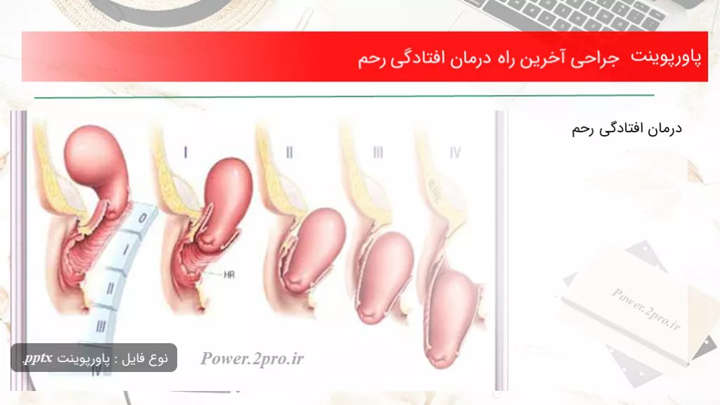 دانلود پاورپوینت جراحی آخرین راه درمان افتادگی رحم - کد110716