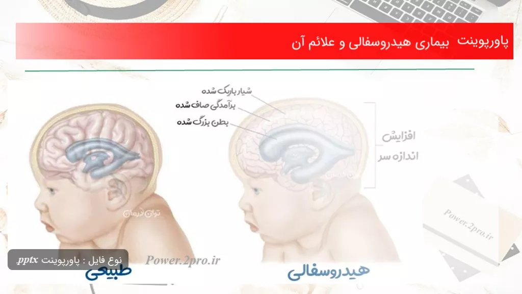 دانلود پاورپوینت بیماری هیدروسفالی و علائم آن - کد111375