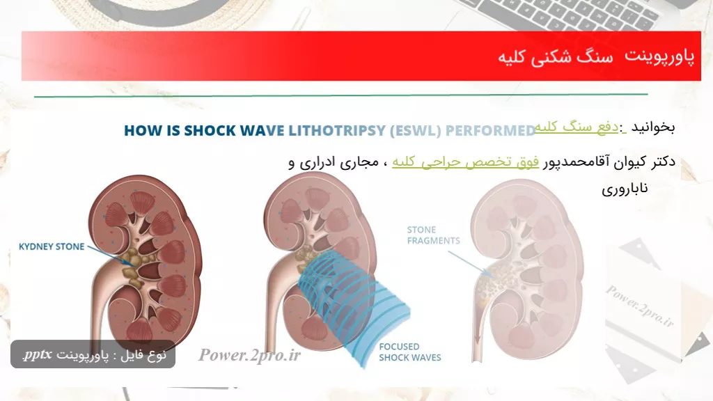 سنگ شکنی کلیه