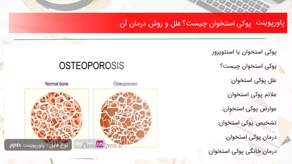 دانلود پاورپوینت پوکی استخوان چه چیزی است ؟ علل و چگونگی درمان آن - کد112324