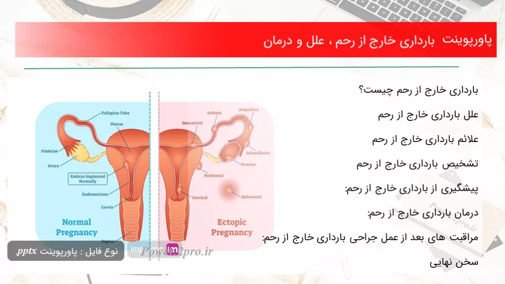 دانلود پاورپوینت بارداری خارج از رحم ، علل و درمان - کد112347