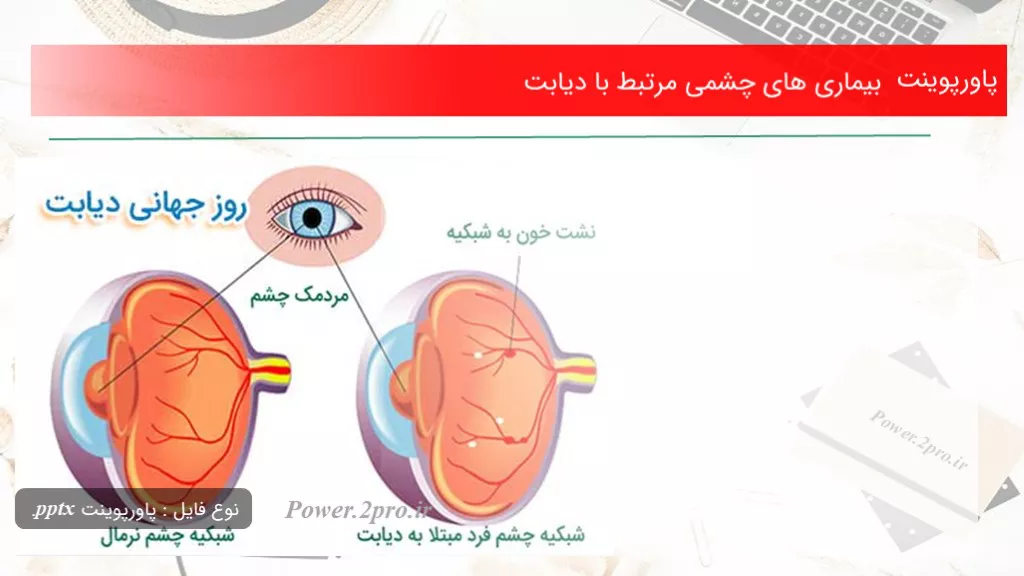 بیماری های چشمی مرتبط با دیابت