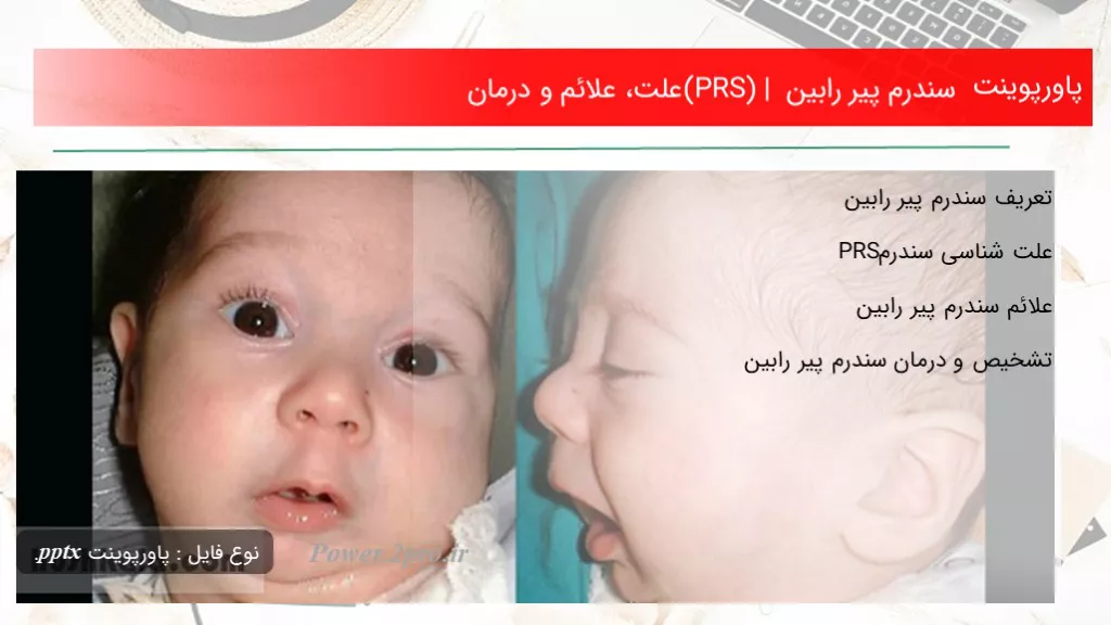 دانلود پاورپوینت سندرم پیر رابین (PRS) | چرایی ، علائم و درمان - کد113410