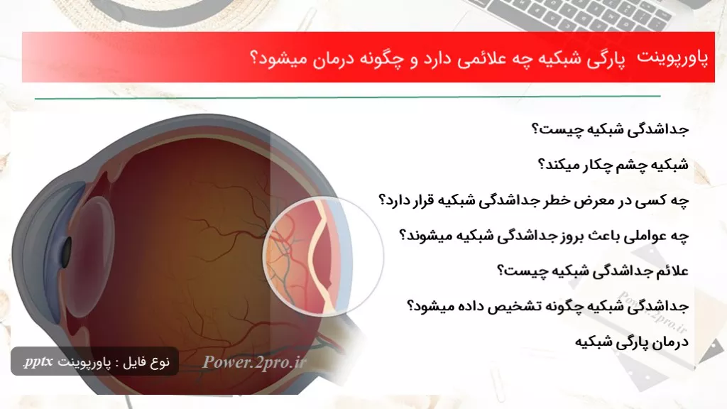 دانلود پاورپوینت پارگی شبکیه چه علائمی دارد و  چطور درمان میشود؟ - کد113496