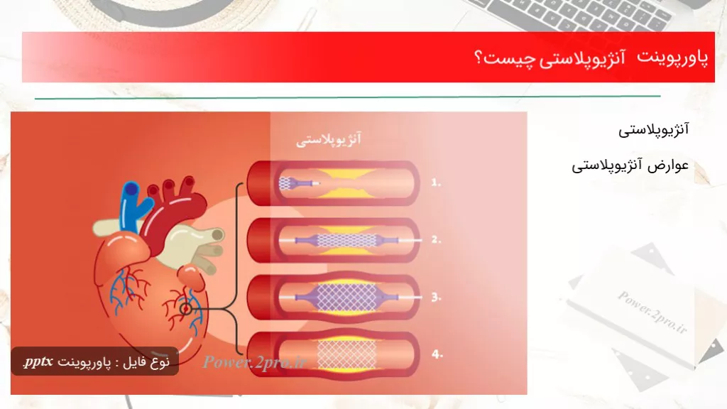 دانلود پاورپوینت آنژیوپلاستی چه چیزی است ؟ - کد114624