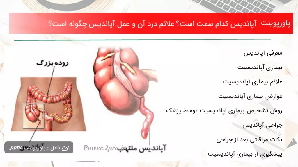 دانلود پاورپوینت آپاندیس کد ام سمت است؟ علائم درد آن و عمل آپاندیس  چطور است؟ - کد116038