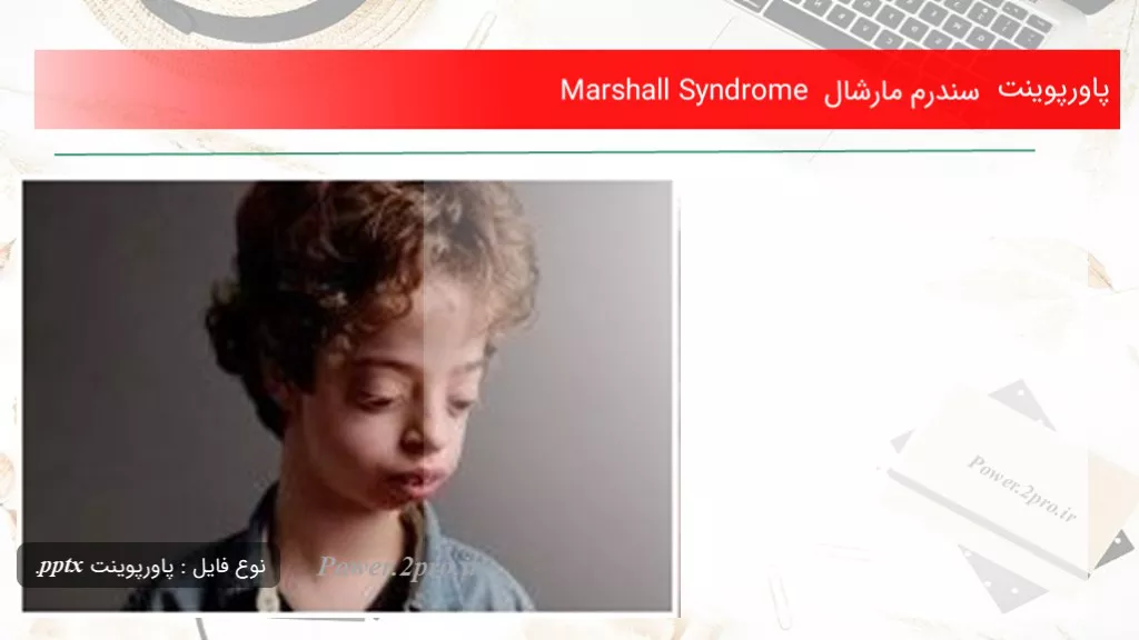 دانلود پاورپوینت سندرم مارشال Marshall Syndrome - کد117733